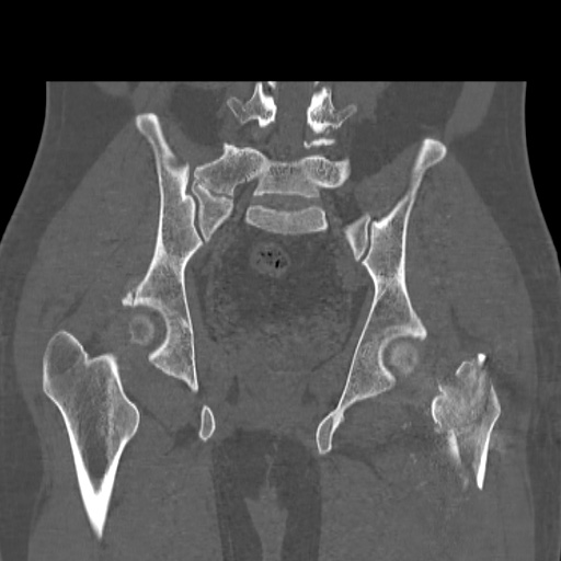 Acetabular and ilial fractures (Radiopaedia 59084-66378 Coronal bone window 34).jpg