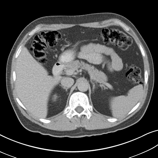 File:Achalasia of the cardia (Radiopaedia 38497-40595 Axial C+ portal venous phase 25).png