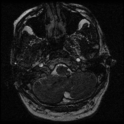File:Acoustic schwannoma (Radiopaedia 39170-41387 Axial FIESTA 27).png