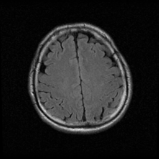 File:Acoustic schwannoma (Radiopaedia 39170-41387 Axial FLAIR 17).png