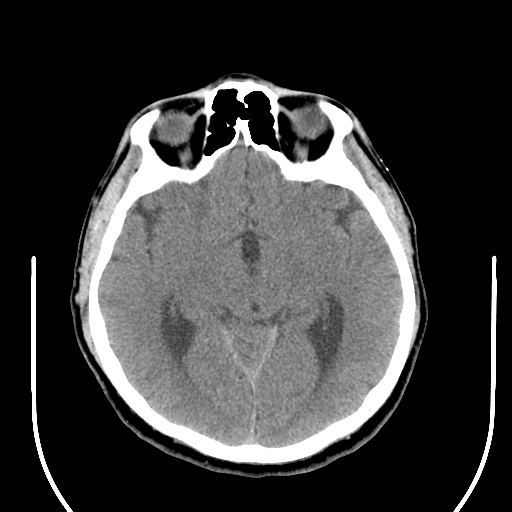 File:Acoustic schwannoma (Radiopaedia 39170-41388 Axial non-contrast 22).png