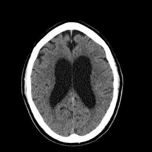File:Acoustic schwannoma (Radiopaedia 55729-62280 Axial non-contrast 22).png