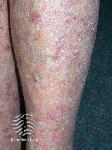 File:Actinic Keratoses affecting the legs and feet (DermNet NZ lesions-ak-legs-564).jpg