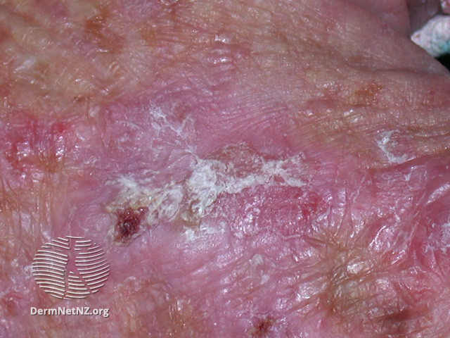 File:Actinic keratoses affecting the hands (DermNet NZ lesions-ak-hands-494).jpg