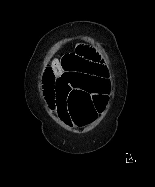 Active Crohn disease (Radiopaedia 59394-66750 Coronal C+ portal venous phase 11).jpg