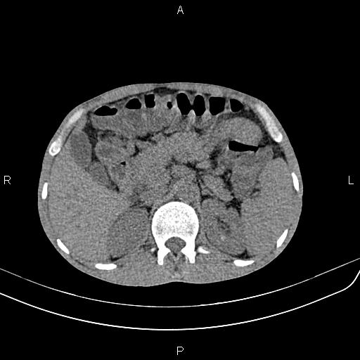Active crohn disease (Radiopaedia 87133-103397 Axial non-contrast 31).jpg