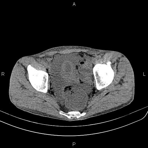 Active crohn disease (Radiopaedia 87133-103397 Axial non-contrast 91).jpg