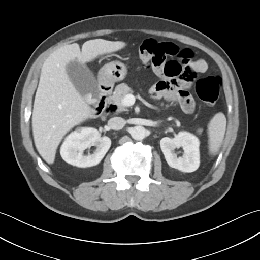 File:Active diverticular hemorrhage (Radiopaedia 39415-41725 Axial C+ portal venous phase 22).png