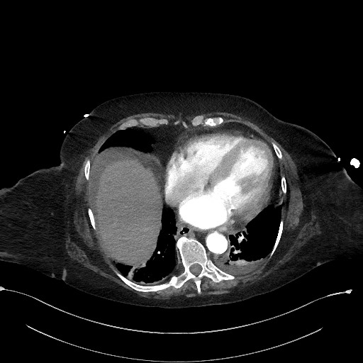 Active renal extravasation with large subcapsular and retroperitoneal hemorrhage (Radiopaedia 60975-68796 Axial C+ arterial phase 19).jpg