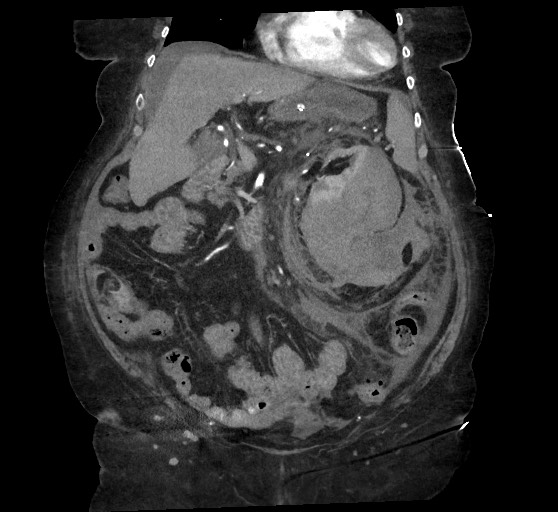 Active renal extravasation with large subcapsular and retroperitoneal hemorrhage (Radiopaedia 60975-68796 Coronal C+ arterial phase 61).jpg