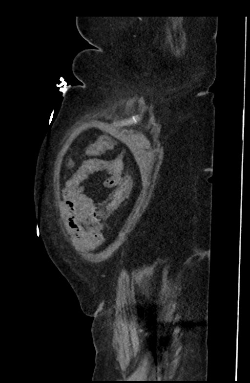 Active renal extravasation with large subcapsular and retroperitoneal hemorrhage (Radiopaedia 60975-68796 Sagittal C+ portal venous phase 193).jpg