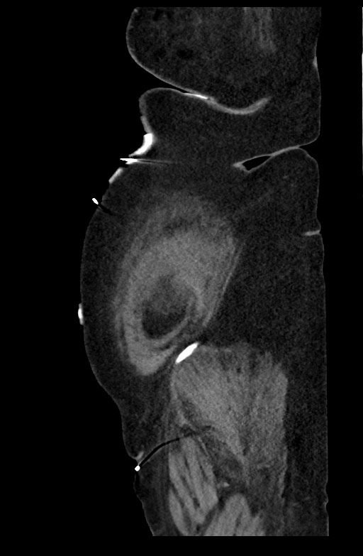 Active renal extravasation with large subcapsular and retroperitoneal hemorrhage (Radiopaedia 60975-68796 Sagittal C+ portal venous phase 40).jpg