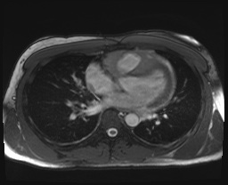 File:Active right ventricular cardiac sarcoidosis (Radiopaedia 55596-62100 Axial SSFP 10).jpg
