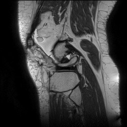 Acute-on-chronic transient lateral patellar dislocation with trochlear dysplasia (Radiopaedia 84099-99349 Sagittal PD 129).jpg