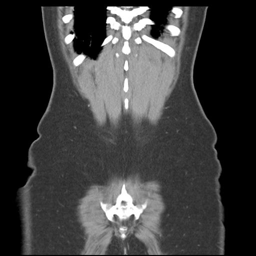 Acute appendicitis (Radiopaedia 30297-30934 Coronal C+ portal venous phase 43).jpg