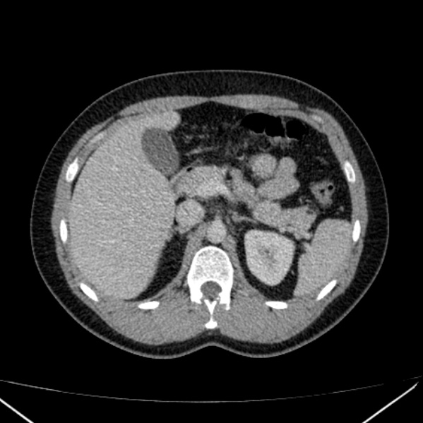 Acute appendicitis (Radiopaedia 38255-40270 Axial C+ portal venous phase 30).jpg