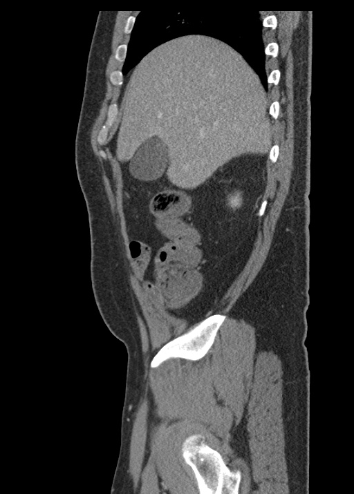 Acute appendicitis (Radiopaedia 48511-53463 Sagittal C+ portal venous phase 35).jpg