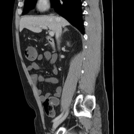 File:Acute appendicitis (Radiopaedia 66513-75790 Sagittal C+ portal venous phase 61).jpg