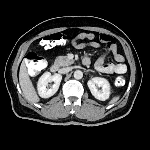 Acute appendicitis (Radiopaedia 77016-88960 Axial C+ portal venous phase 54).jpg