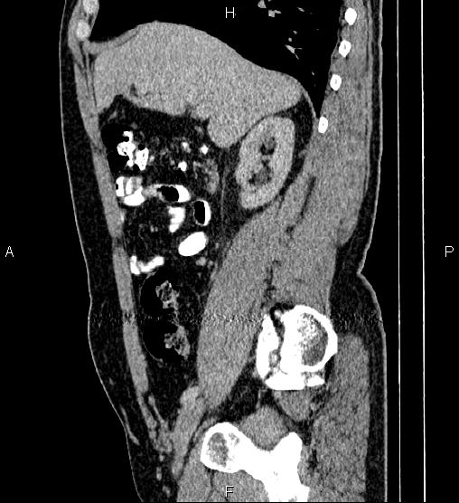 Acute appendicitis (Radiopaedia 84780-100240 Sagittal C+ portal venous phase 34).jpg
