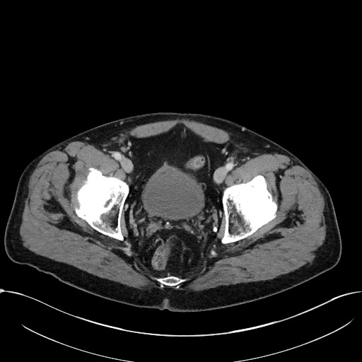 Acute appendicitis - large appendicoliths (Radiopaedia 61805-69820 Axial C+ portal venous phase 118).jpg