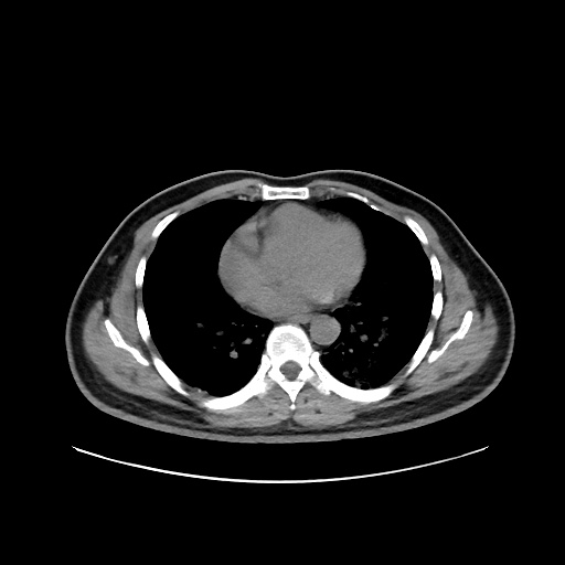 Acute appendicitis and COVID 19 pneumonia (Radiopaedia 76604-88380 Axial non-contrast 33).jpg