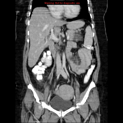 Acute appendicitis complicated by ovarian vein thrombophlebitis (Radiopaedia 16172-15851 Coronal C+ portal venous phase 40).jpg