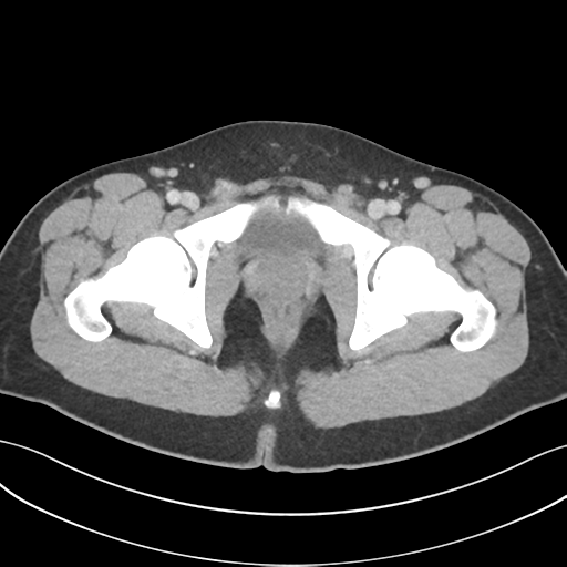 File:Acute appendicitis with appendicoliths (Radiopaedia 50186-55532 Axial C+ portal venous phase 82).png