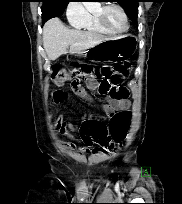Acute arterial mesenteric ischemia (Radiopaedia 78238-90828 Coronal C+ portal venous phase 29).jpg