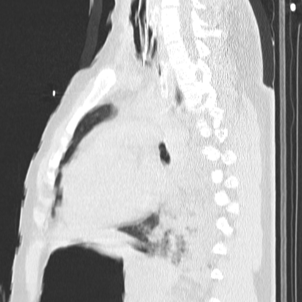 Acute aspiration pneumonitis (Radiopaedia 33605-34703 Sagittal lung window 51).jpg