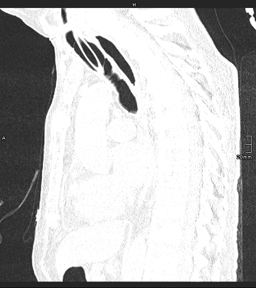 Acute aspiration pneumonitis (Radiopaedia 55642-62166 Sagittal lung window 77).jpg