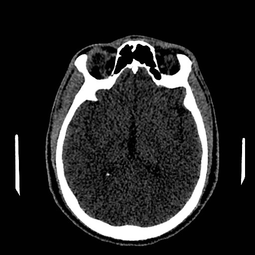 Acute basilar artery occlusion (Radiopaedia 43582-46985 Axial non-contrast 94).jpg