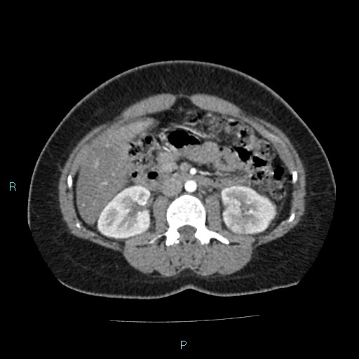 File:Acute bilateral pyelonephritis (Radiopaedia 37146-38881 Axial C+ arterial phase 86).jpg