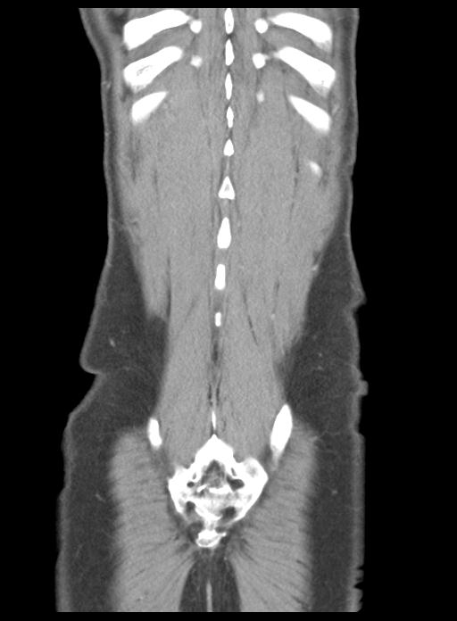 Acute cholecystitis (Radiopaedia 29814-30327 Coronal C+ portal venous phase 47).jpg