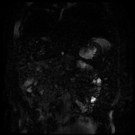 Acute cholecystitis and biliary hamartomas (Radiopaedia 86231-102240 E 136).jpg