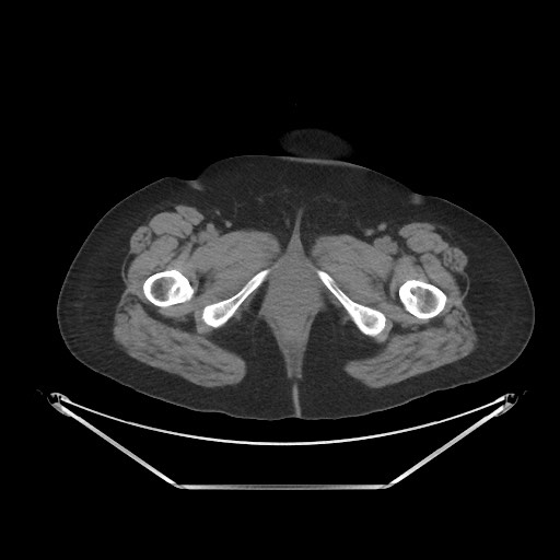 File:Acute cholecystitis with tensile fundus sign (Radiopaedia 71394-81723 Axial non-contrast 128).jpg