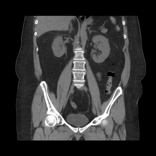 Acute cholecystitis with tensile fundus sign (Radiopaedia 71394-81723 Coronal non-contrast 73).jpg