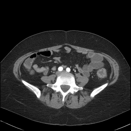 Acute colonic hemorrhage in ulcerative colitis (Radiopaedia 77415-89538 Axial C+ arterial phase 85).jpg