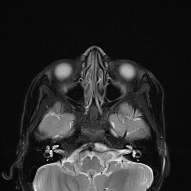 File:Acute disseminating encephalomyelitis with bilateral optic neuritis (Radiopaedia 79676-92886 Axial STIR 4).jpg