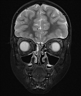 File:Acute disseminating encephalomyelitis with bilateral optic neuritis (Radiopaedia 79676-92886 Coronal STIR 6).jpg