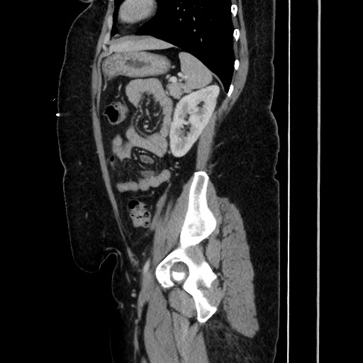 Acute diverticulitis - transverse colon (Radiopaedia 87063-103327 Sagittal C+ portal venous phase 158).jpg