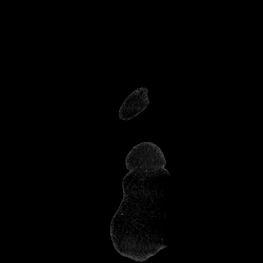 Acute diverticulitis - transverse colon (Radiopaedia 87063-103327 Sagittal C+ portal venous phase 8).jpg