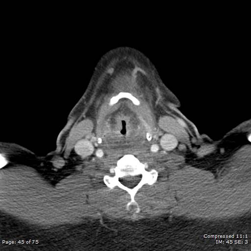 Acute epiglottitis (Radiopaedia 54375-60590 Axial C+ arterial phase 45).jpg