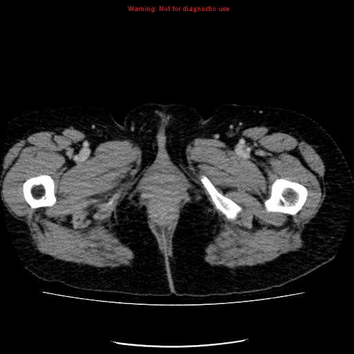 Acute gangrenous cholecystitis (Radiopaedia 10123-10661 Axial C+ portal venous phase 111).jpg