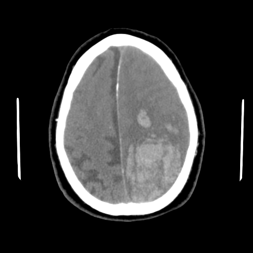 File:Acute hemorrhagic stroke (Radiopaedia 17507-17223 Axial non-contrast 40).jpg