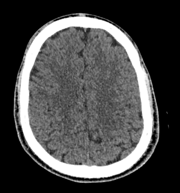 Acute ischemic stroke - posterior circulation territory (Radiopaedia 77670-89881 non-contrast 66).jpg