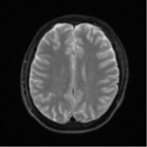 Acute left middle cerebral artery territory infarct with clot retrieval (Radiopaedia 47732-52433 Axial DWI 20).png