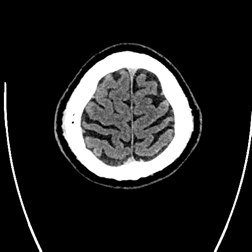 Acute left middle cerebral artery territory ischemic stroke (Radiopaedia 35688-37223 Axial non-contrast 77).png