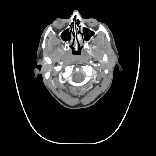 Acute longus colli calcific tendinitis (Radiopaedia 72495-83036 Axial C+ arterial phase 13).jpg