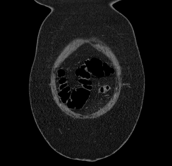 Acute mesenteric ischemia (Radiopaedia 80029-93316 Coronal C+ arterial phase 3).jpg